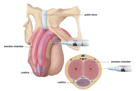 Penile Alprostadil Injection - NU Hospitals