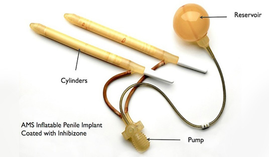 Inflatable penile Implant in anatomical position - NU Hospitals