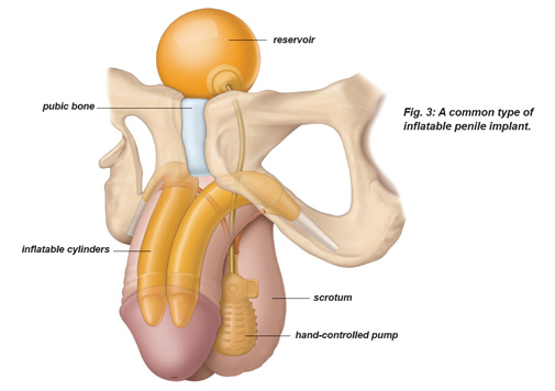 Inflatable Penile Implant in Anatomical Position - NU Fertility