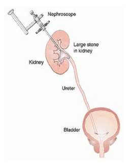 Best Kidney Stone Surgery Hospitals in Bangalore