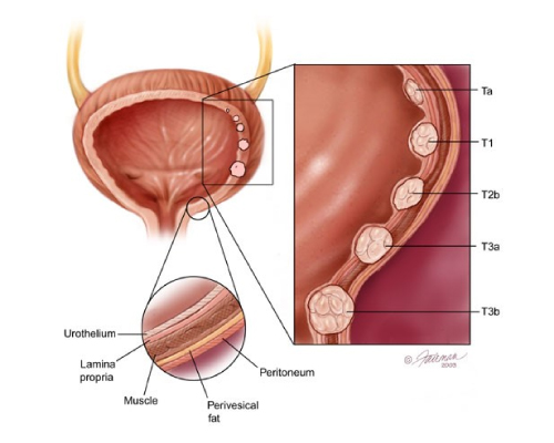 Urinary Bladder Cancer Treatment in Bangalore, India | Kidney Stones