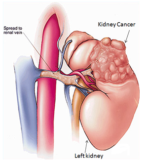 Kidney Cancer Treatment & Surgery in Bangalore | Kidney Tumors India