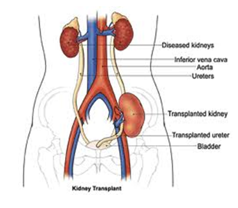 Deceased Donor Kidney Transplantation - NU Hospitals