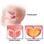 Prostate Enlargement - NU Hospitals