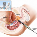 Transrectal Prostate Biopsy - NU Hospitals