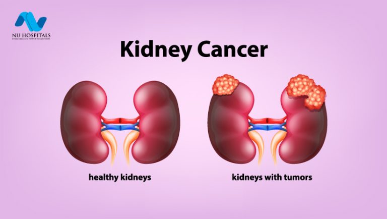 Kidney Cancer: Symptoms, Causes & Diagnosis Treatment
