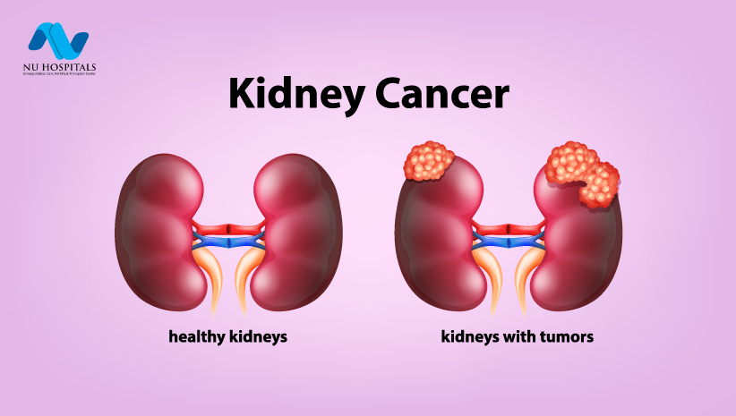 Kidney Cancer Symptoms Causes And Treatment Nu Hospitals
