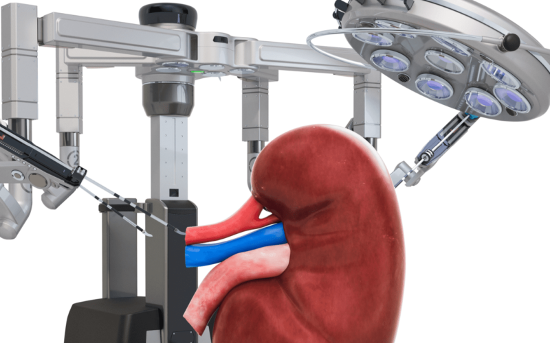 Robotic surgery of the kidney concept - NU Hospitals