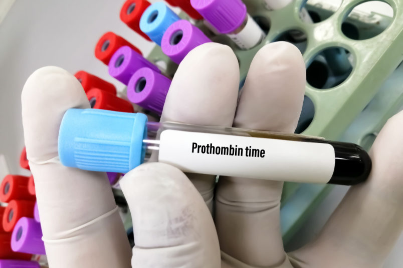 Blood sample for Prothrombin Time - NU Hospitals