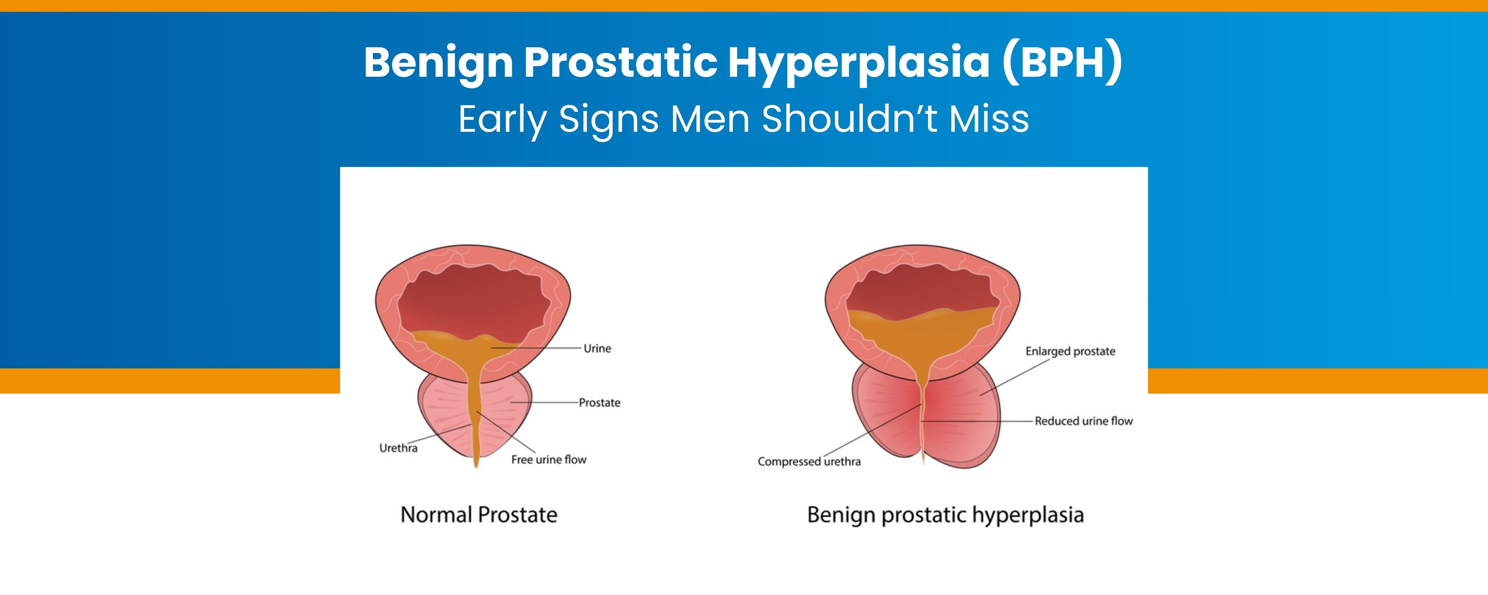Benign Prostatic Hyperplasia (BPH): Early Signs Men Shouldn’t Miss