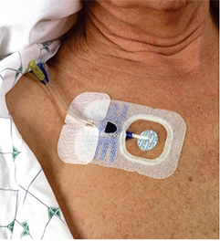 Central Line Associated Blood Stream Infection And Care Of Central Line