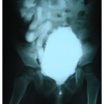 Neurogenic Bladder