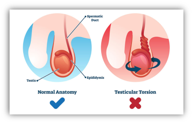 Testicular torsion