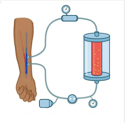 hemodialysis