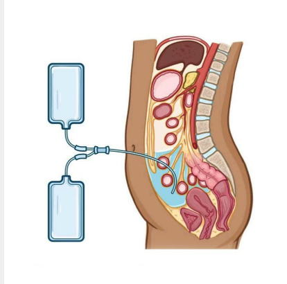 Diagram of peritoneal dialysis, showing a tube inserted in the abdomen connected to dialysis solution bags outside the body.