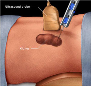 Renal (Kidney) biopsy