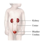 Urinary Tract Infection (UTI) in Children
