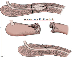 anastomotic urethroplasty