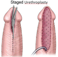 staged urethroplasty 