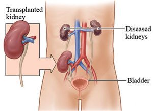 Kidney Transplant in Bangalore